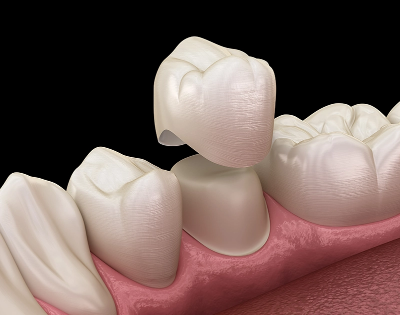 Dental crown restoration