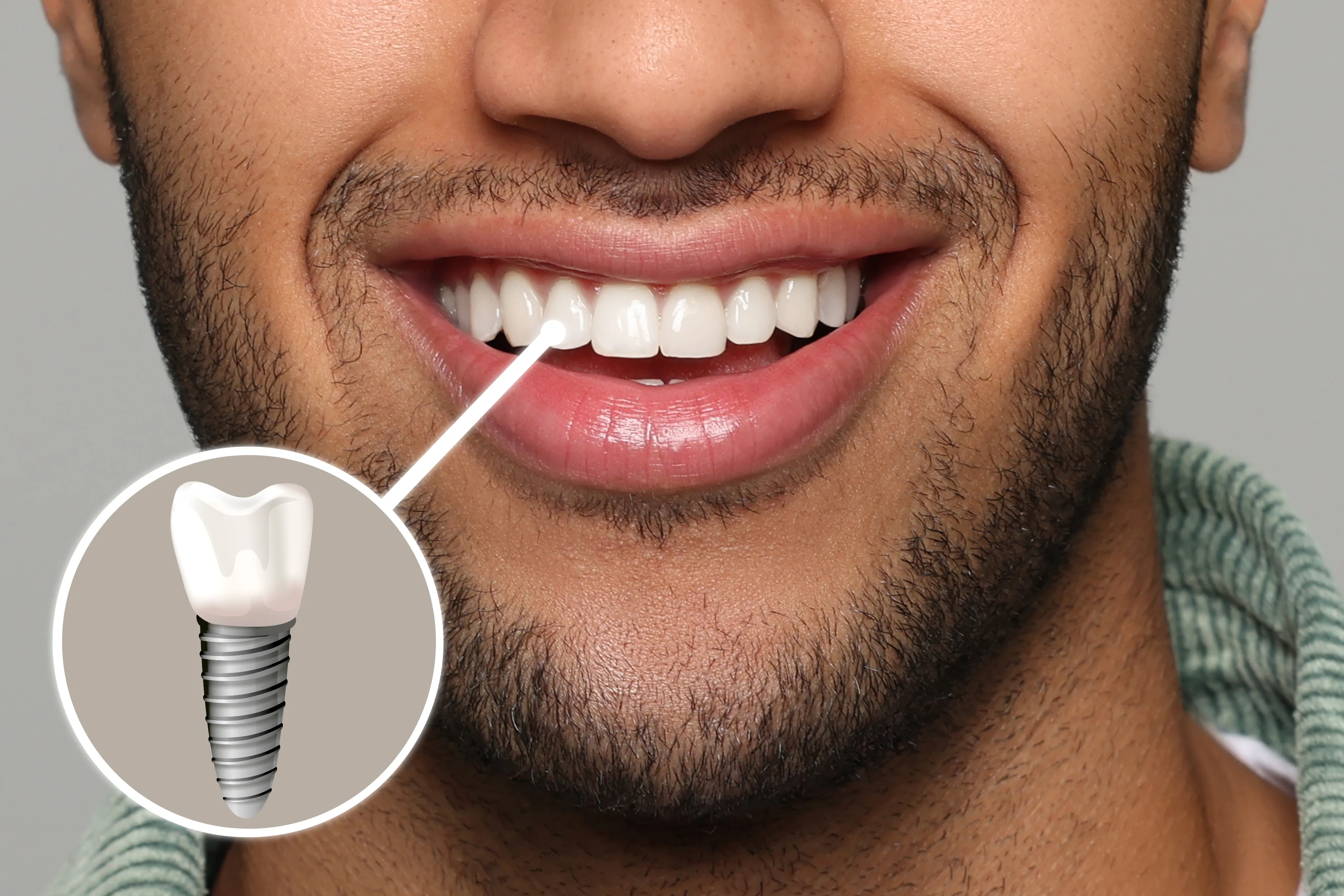 Implant Dentistry in Wheaton, IL