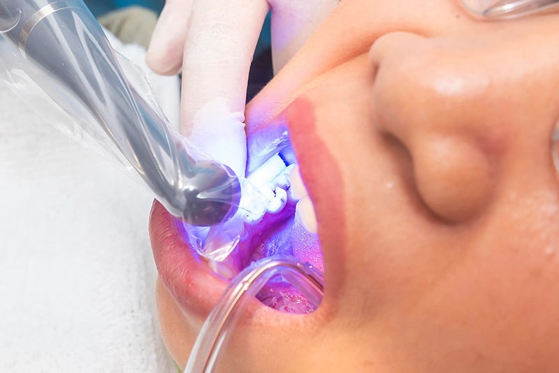 Dental Bonding